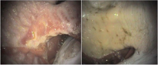 Squamous gastric ulcers - 28 day healing