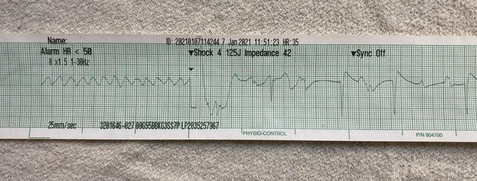 Rhythm strip from TVEC