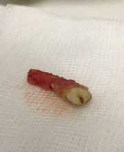 Extracted_wolf_tooth_with_long_intact_root__red__and_small_clinical_crown__white