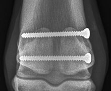 Orthopaedic x-ray showing pins in leg